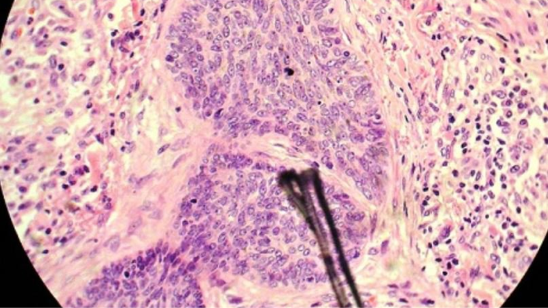 Phương pháp liqui prep trong xét nghiệm tế bào học 2