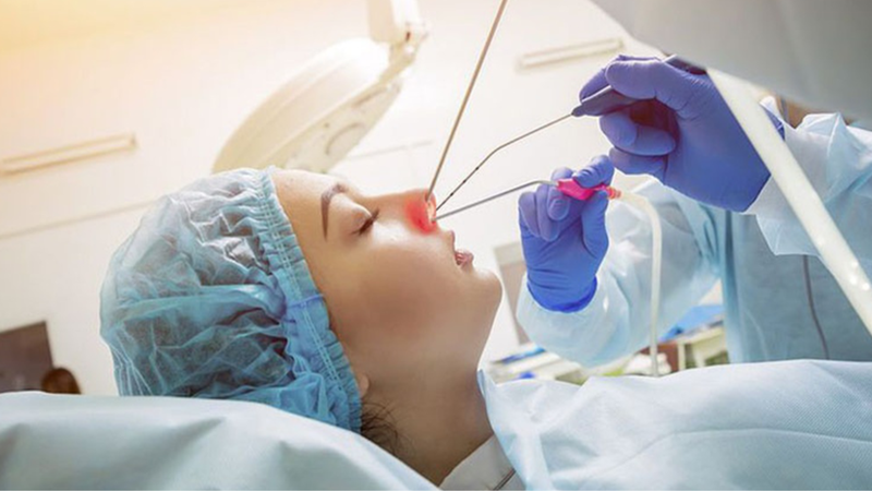 Phương pháp mổ xoang và những biến chứng có thể gặp 3