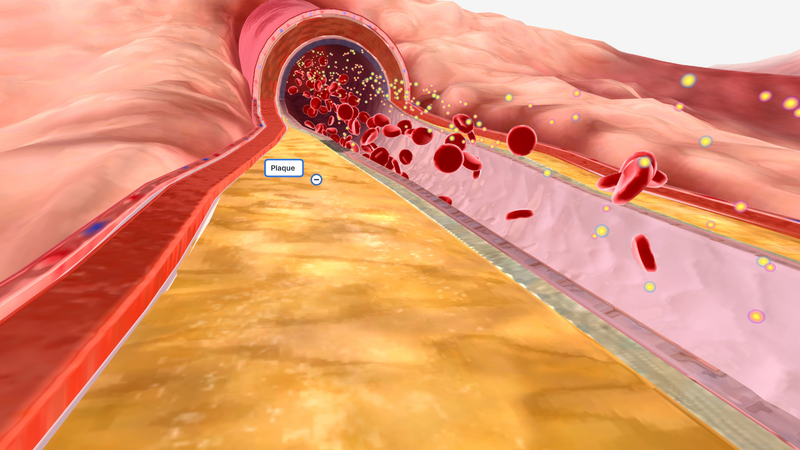 Phương pháp MRI mới có thể dự đoán nguy cơ mắc bệnh tim bằng cách phân tích mỡ tim 3