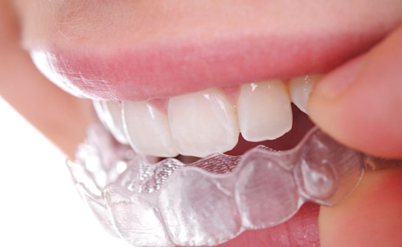 Tìm hiểu về phương pháp niềng răng không mắc cài 3d clear