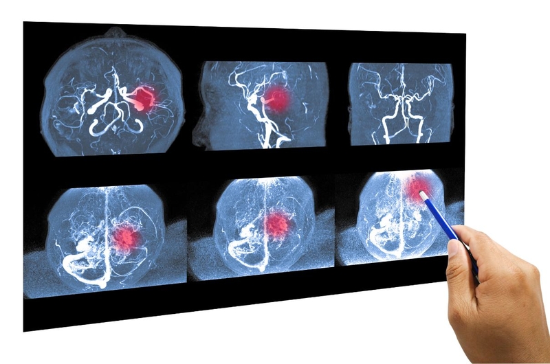 Tìm hiểu chi tiết về phương pháp nút túi phình động mạch não 2