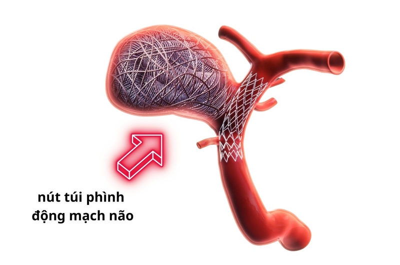 Tìm hiểu chi tiết về phương pháp nút túi phình động mạch não 3