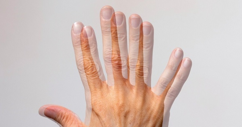 Phương pháp phẫu thuật mắt lác: Quy trình và những rủi ro tiềm ẩn 4