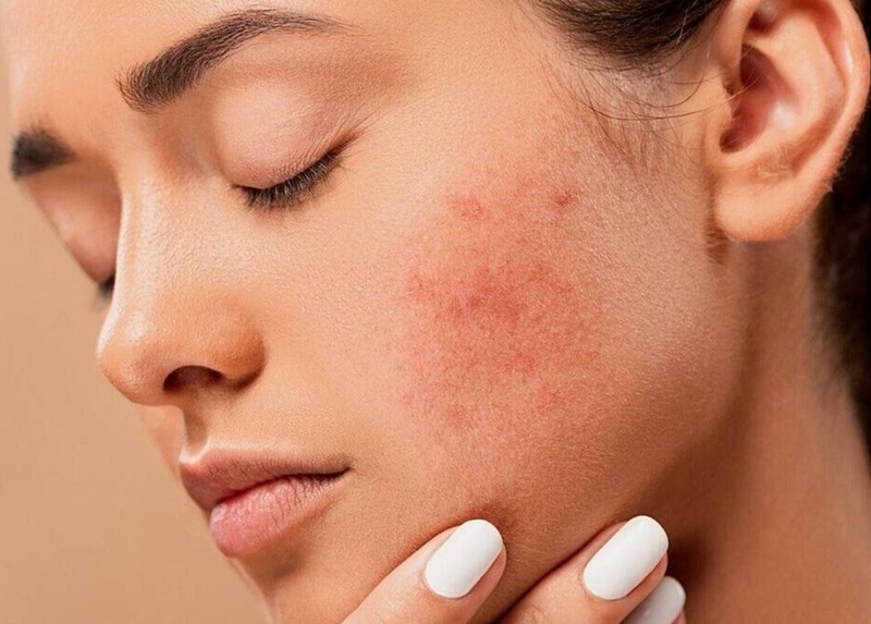 Phương pháp phi kim trị mụn là gì và một số thông tin cần biết 2