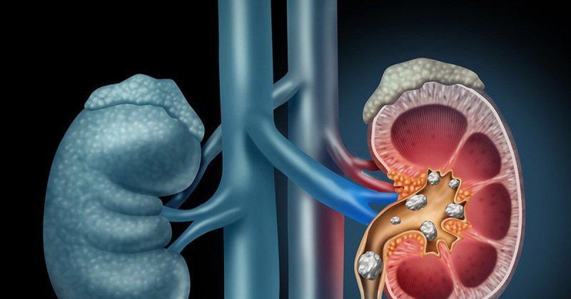 Phương pháp phòng tránh bệnh sỏi tiết niệu 1