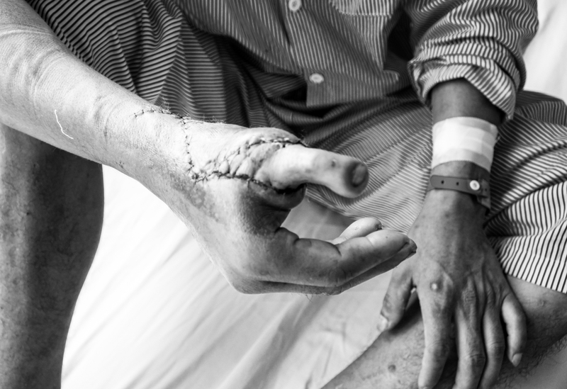 Phương pháp phục hồi ngón tay cái bằng cách phẫu thuật 3