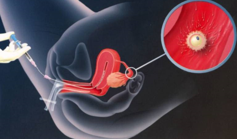 Sử dụng tinh trùng hiến tặng để thụ tinh nhân tạo