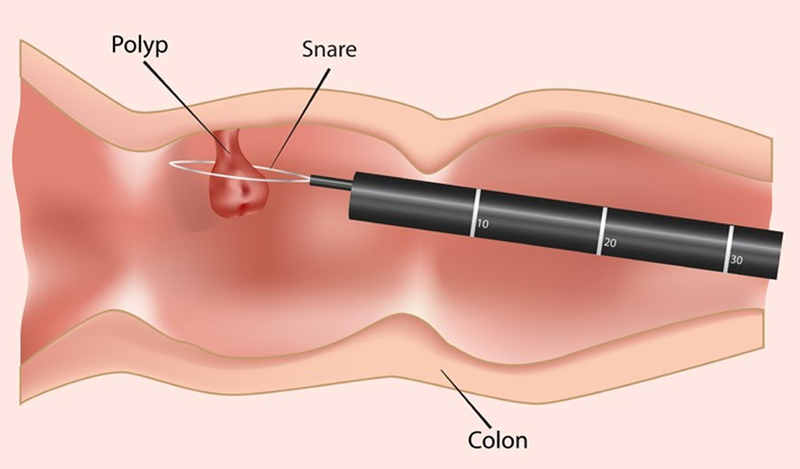 Tầm soát ung thư đại trực tràng