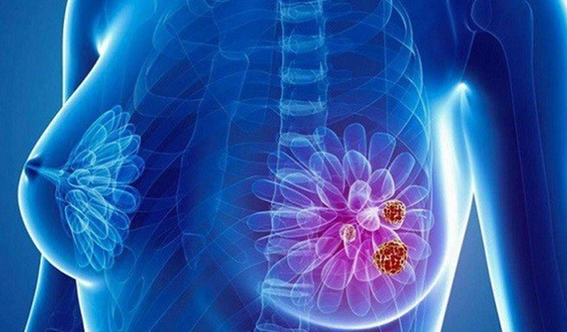 Thực hiện tầm soát ung thư vú ở nữ giới