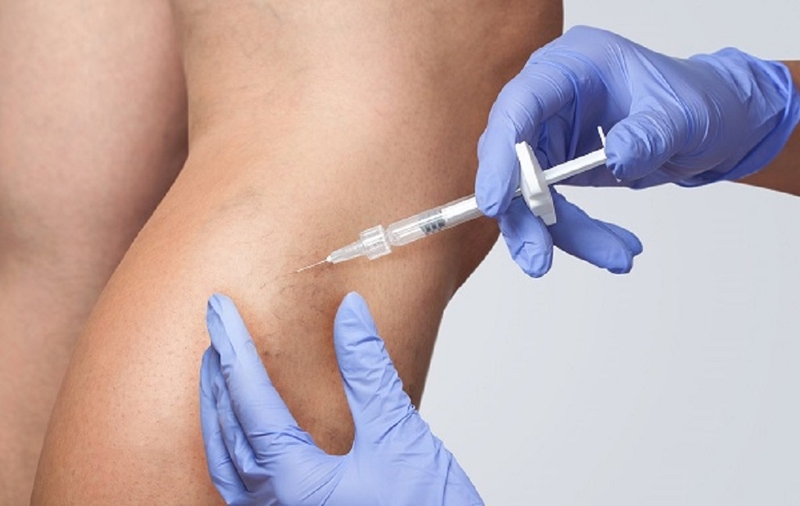 Phương pháp tiêm xơ tĩnh mạch là gì? Quy trình thực hiện kỹ thuật tiêm xơ tĩnh mạch 2