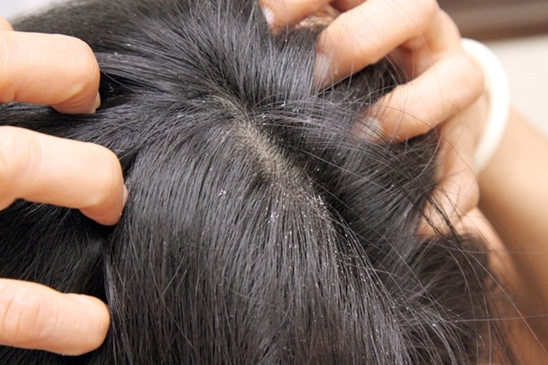 Phương pháp trị chấy bằng cà chua hiệu quả 1