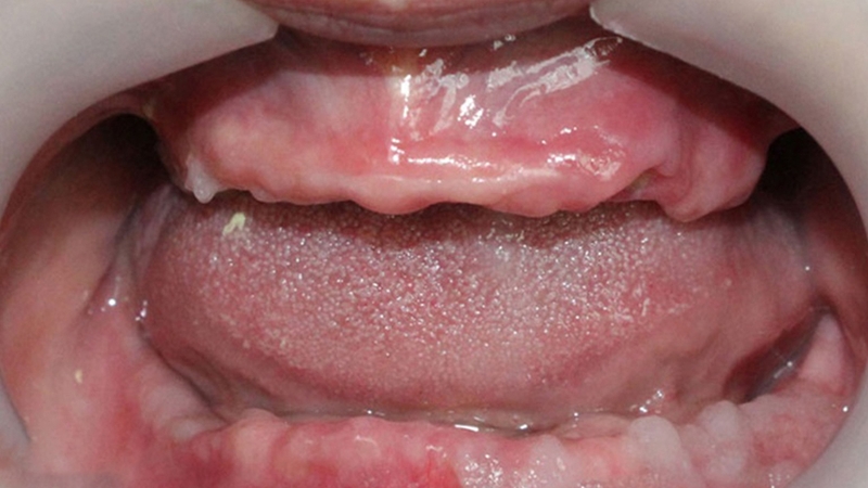 Phương pháp trồng răng All on 4: Tổng quan, ưu điểm và quy trình cấy ghép 3