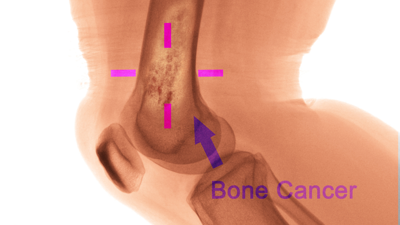 Phương pháp xạ trị di căn xương trong điều trị ung thư 1