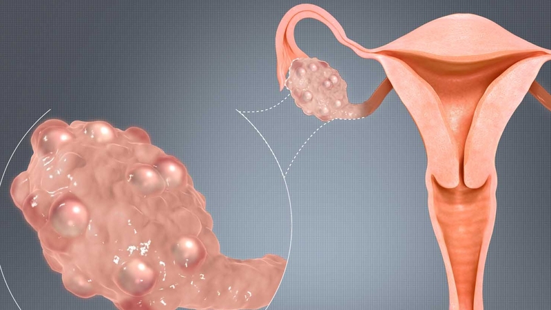 Phương pháp xét nghiệm máu chẩn đoán đa nang buồng trứng 1