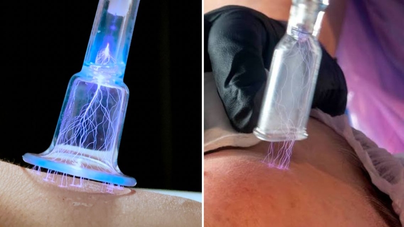 Plasma lạnh hoạt động ở nhiệt độ thấp, hỗ trợ điều trị mà không gây tổn thương nhiệt cho mô