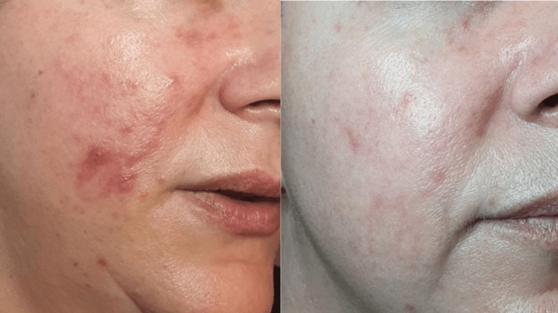 Công nghệ plasma lạnh giúp kiểm soát vi khuẩn và hỗ trợ quá trình lành vết thương