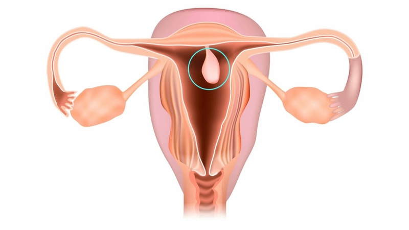 Polyp buồng tử cung là gì? Nguyên nhân, triệu chứng và cách điều trị 1