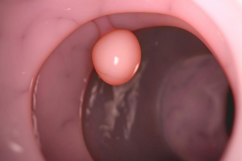 Polyp cổ tử cung và những điều cần biết 1