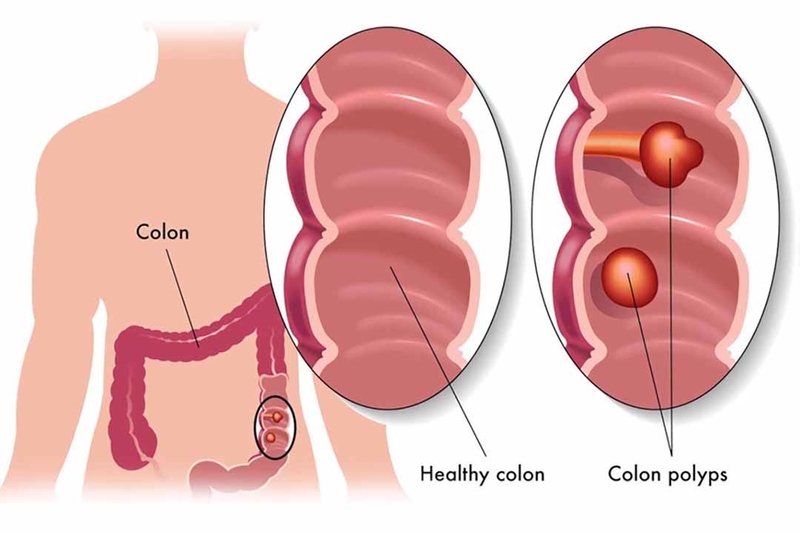 Những thông tin về hội chứng Polyp Juvenile2