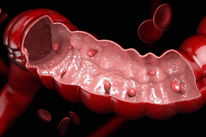 Bệnh đa polyp đại tràng có nguy cơ tiến triển thành ung thư dại tràng cao hơn các loại khác