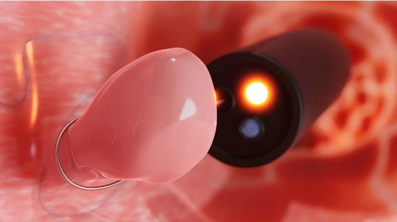 Polyp đại tràng nghịch sản và những điều cần biết -1