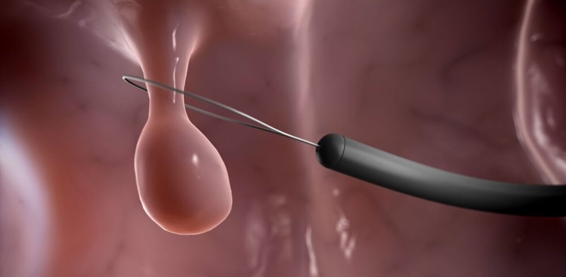 Polyp đại tràng nghịch sản và những điều cần biết -3