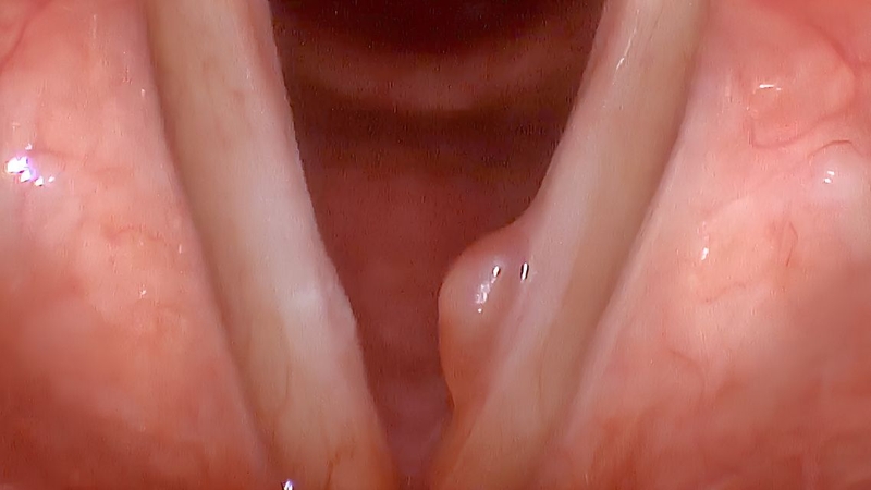 Polyp dây thanh có thể gây khàn tiếng và thay đổi giọng nói