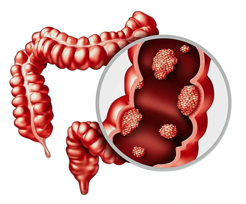 Polyp loạn sản đại tràng, nguyên nhân và cách điều trị.