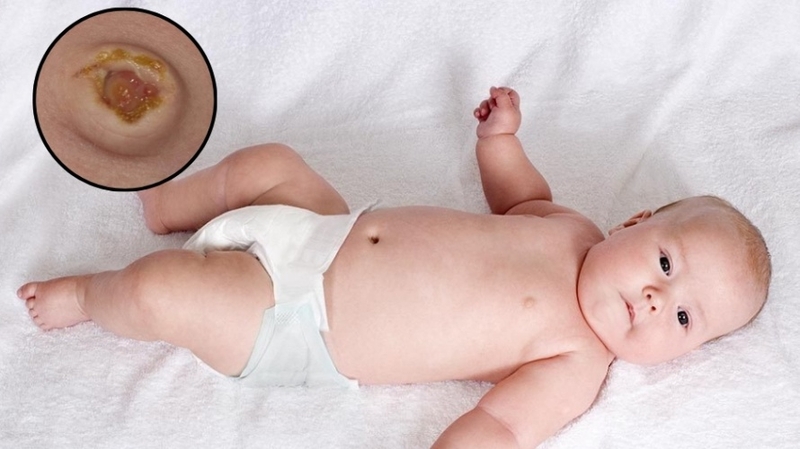 Polyp rốn ở trẻ sơ sinh: Dấu hiệu nhận biết và cách điều trị 1