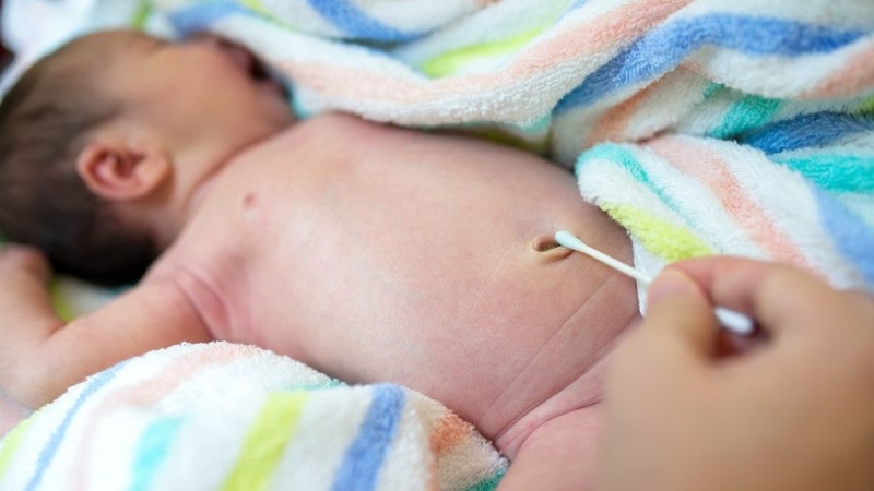 Polyp rốn ở trẻ sơ sinh: Dấu hiệu nhận biết và cách điều trị 2