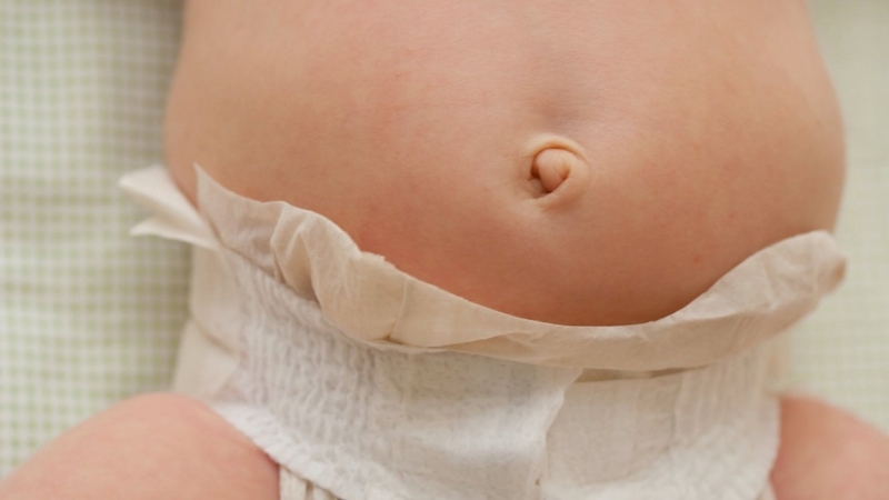 Polyp rốn ở trẻ sơ sinh: Dấu hiệu nhận biết và cách điều trị 3