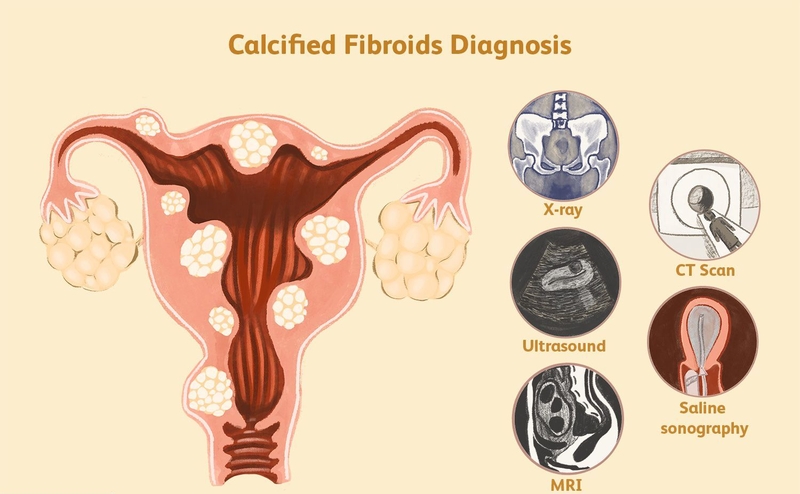 Polyp tử cung là gì? Cách phân biệt polyp tử cung và u xơ tử cung 4