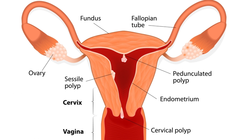Polyp tử cung là gì? Cách phân biệt polyp tử cung và u xơ tử cung 1
