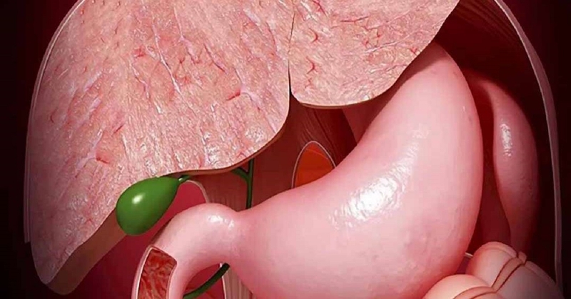 Polyp túi mật 10mm có đáng sợ? Khi nào cần cắt bỏ?