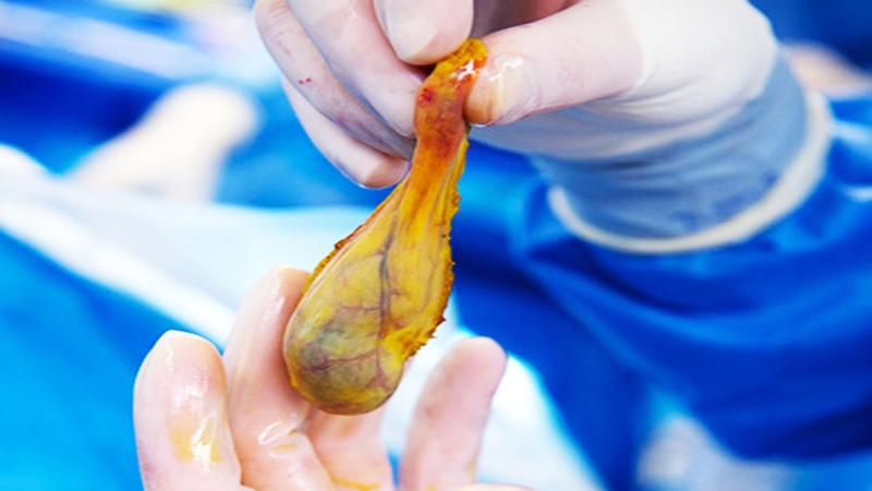 Polyp túi mật 10mm có đáng sợ? Khi nào cần cắt bỏ? 3