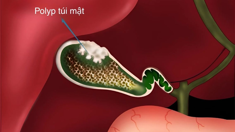 Polyp túi mật bao nhiêu thì phải cắt? Polyp lớn hông cắt có sao không 1