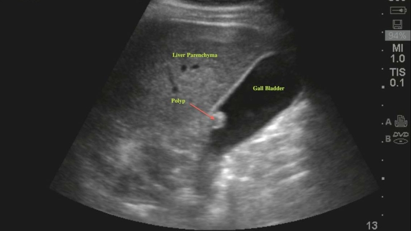 Polyp túi mật bao nhiêu thì phải cắt? Polyp lớn hông cắt có sao không 4