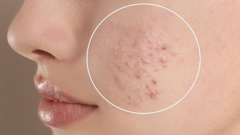 prolactin-cao-co-gay-vo-sinh-khong-nhung-dieu-can-biet-ve-hormone-nay 4