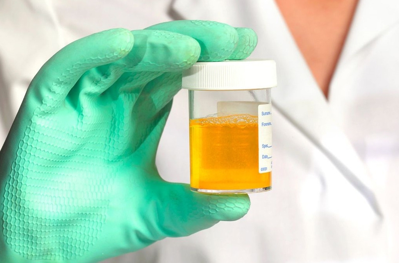 Protein toàn phần là gì? Những điều cần biết về xét nghiệm protein toàn phần 3