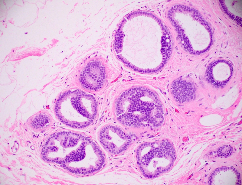 Quá sản không điển hình tuyến vú có phải là ung thư? 2