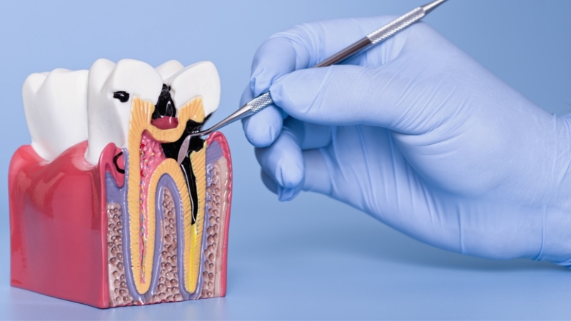 Quá trình bị sâu răng tiến triển âm thầm do vi khuẩn tạo axit phá hủy men răng theo thời gian