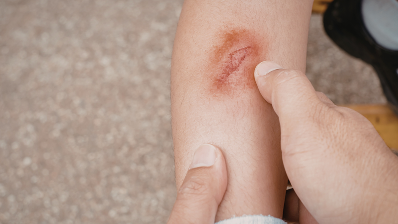 Ở điều kiện thông thường, quá trình lành thương sẽ trải qua nhiều giai đoạn nối tiếp nhau