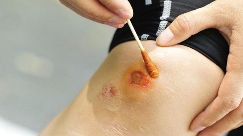 Quá trình liền vết thương diễn ra như thế nào? 1