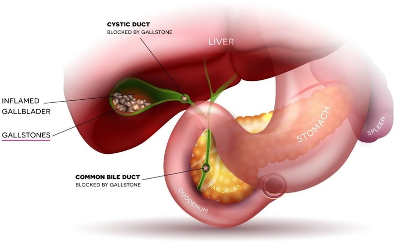 Quá trình sinh thiết đường mật qua da dưới X quang tăng sáng 2