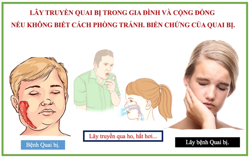 Quai bị có lây không? Bệnh quai bị lây qua đường nào? 3
