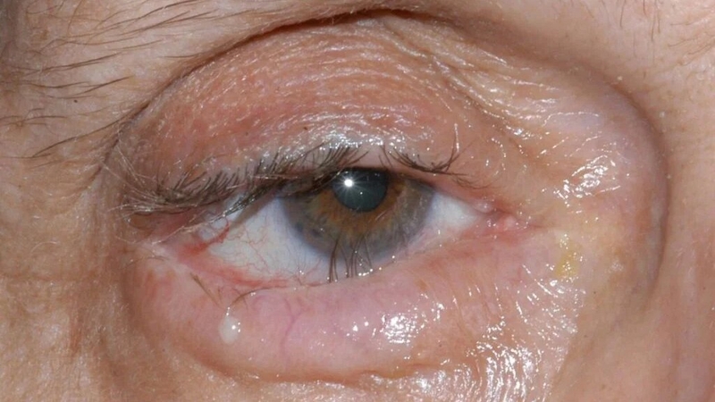 Quặm và lông xiêu của mí mắt là bệnh gì và nó nguy hiểm ra sao? 3