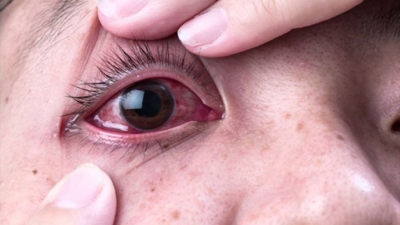 Quặm và lông xiêu của mí mắt là bệnh gì và nó nguy hiểm ra sao? 4