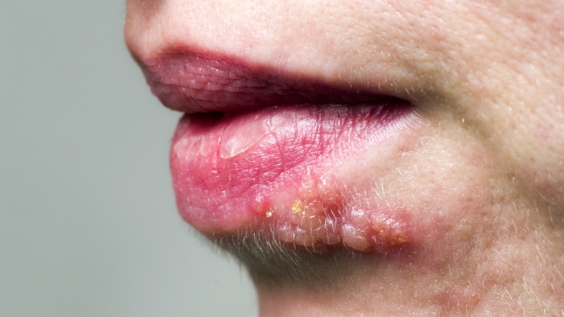 Quan hệ bằng miệng có nguy cơ lây bệnh gì? Cách phòng ngừa STIs khi quan hệ bằng miệng 4