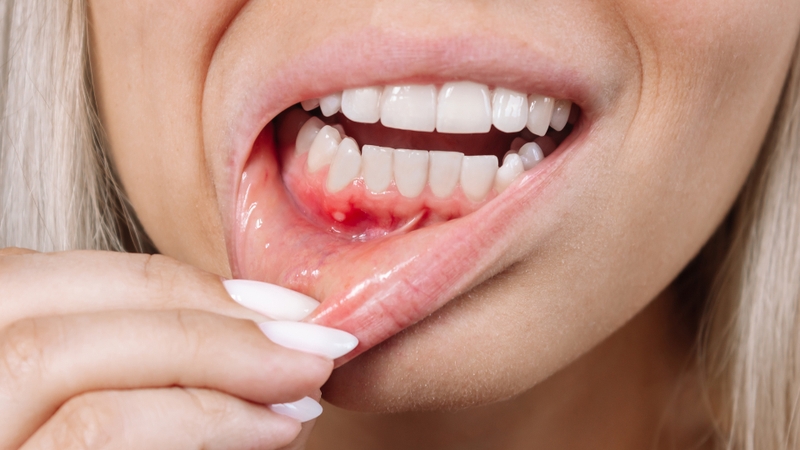 Quan hệ bằng miệng có nguy cơ lây bệnh gì? Cách phòng ngừa STIs khi quan hệ bằng miệng 2