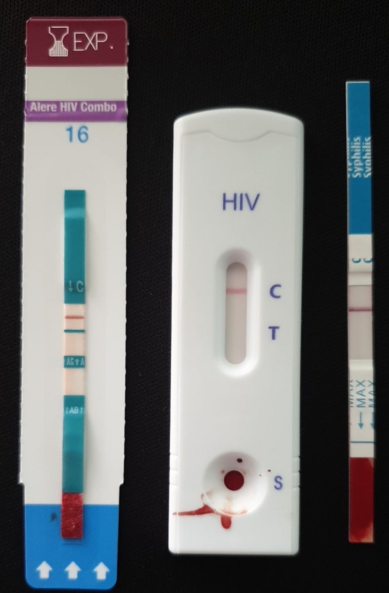 Que test HIV là gì? Những điều mà bạn cần lưu ý khi sử dụng que test HIV 1